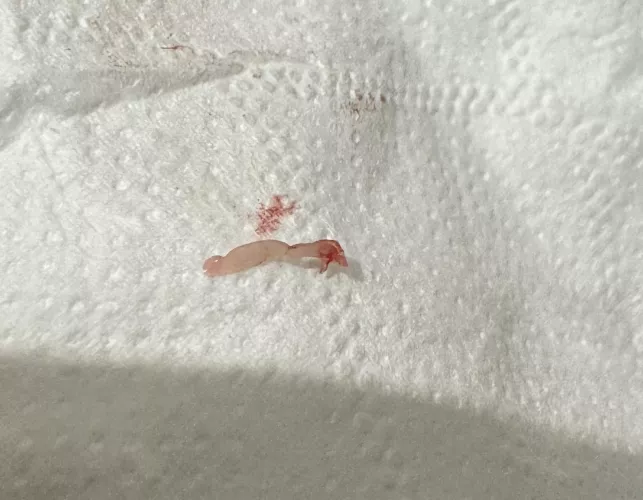 Cyst extracted thing?