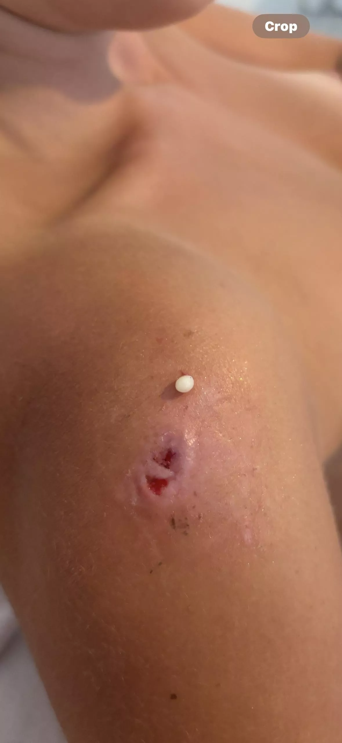 My recurring friend- tried an alternative removal process and didn't film as I didn't expect it to work!