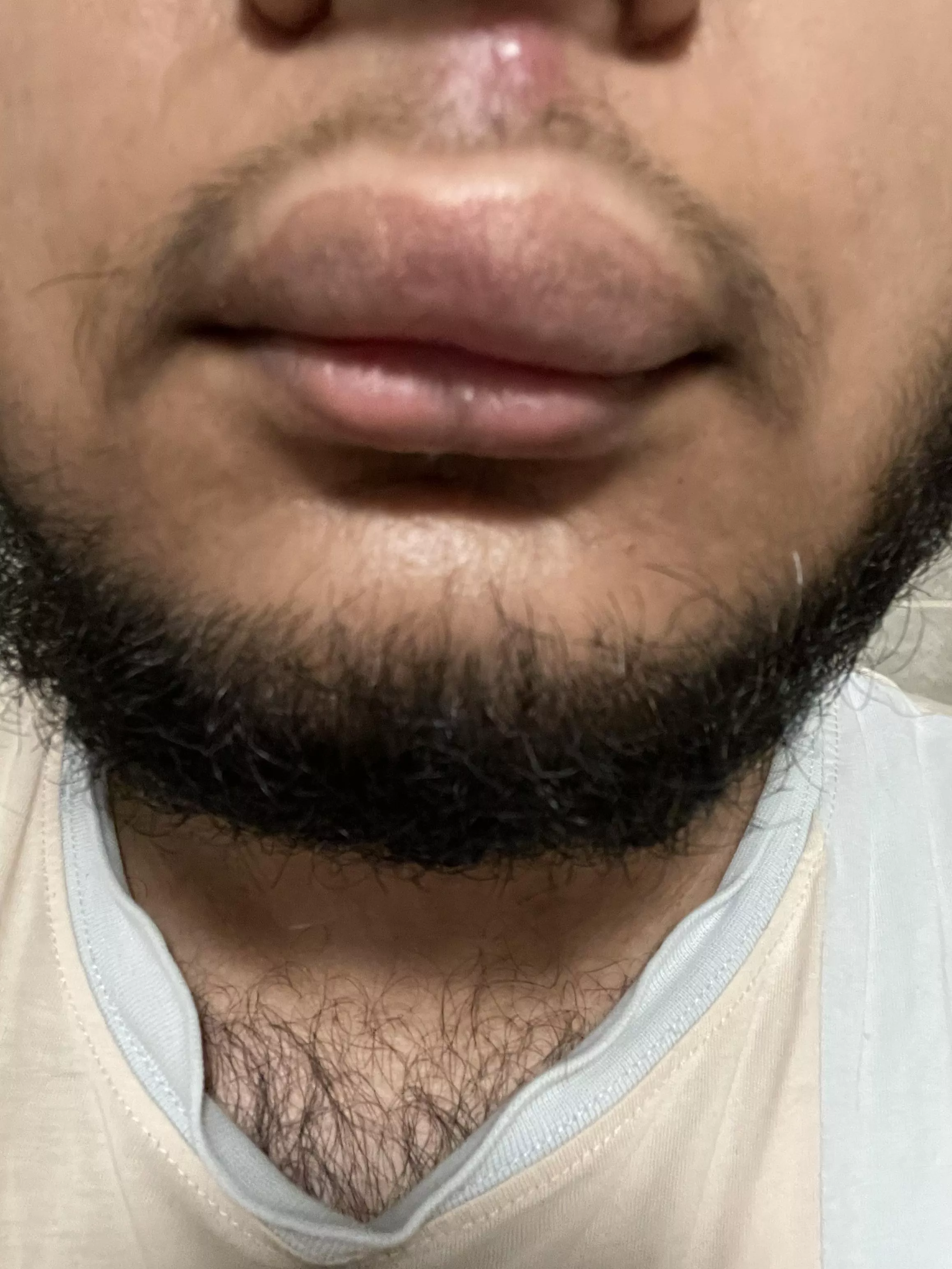 Popped a pimple on my lip and now it looks like this