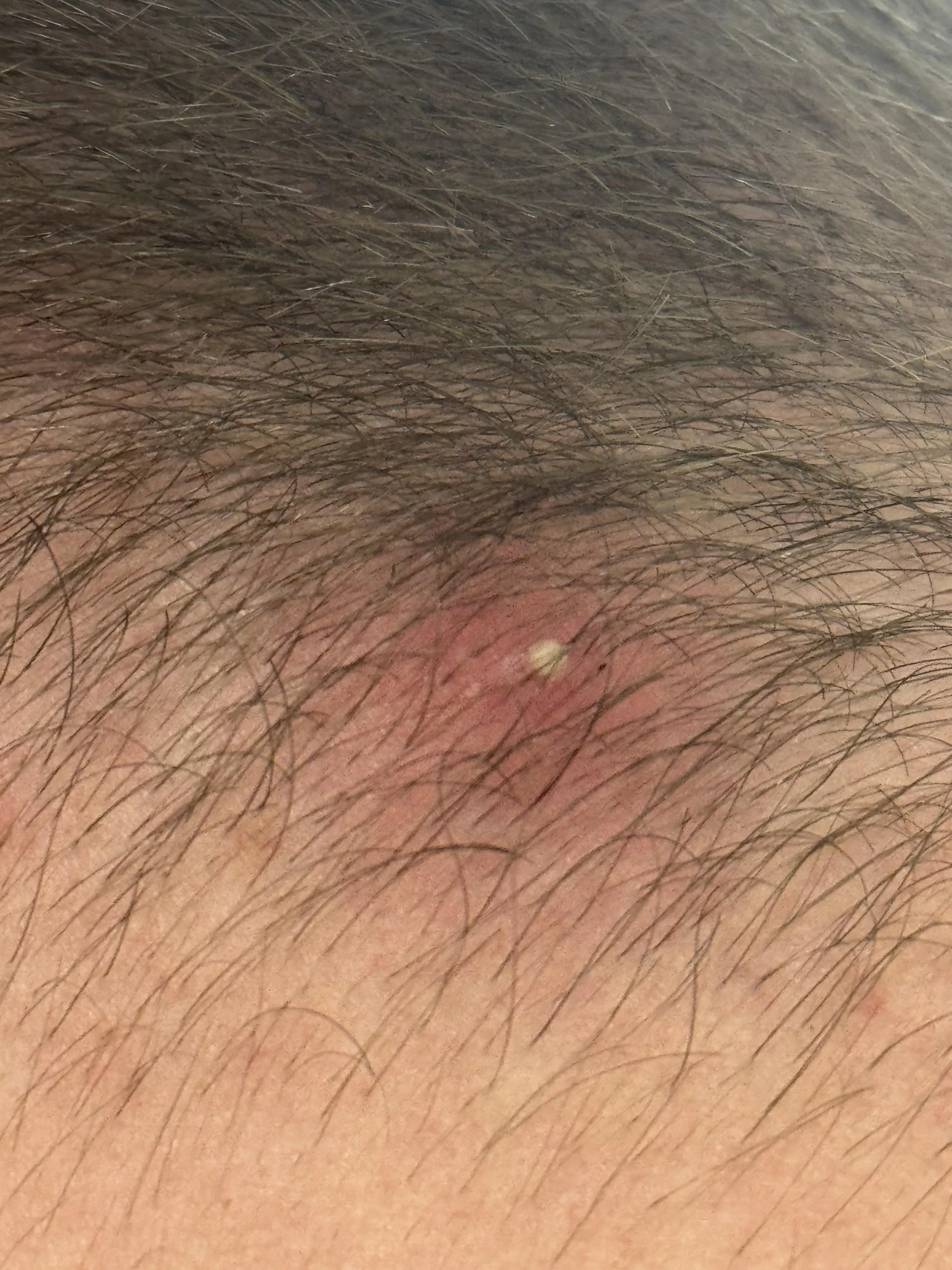 Beautiful Ingrown on my head I’ll record for ya’ll soon