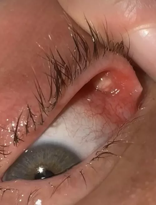 Currently have three of these in one eye