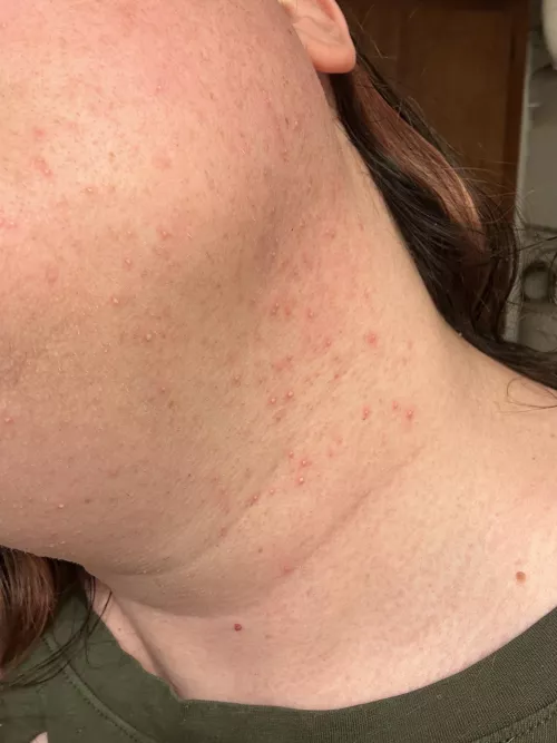 This is what my neck looks likes for a few days after doing laser hair removal. 