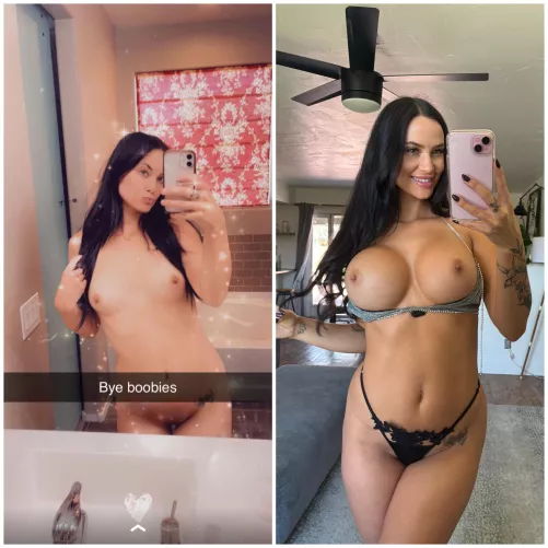 the night before my surgery VS 4 years later