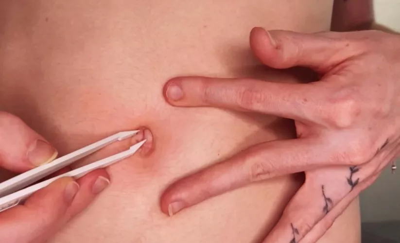 Bellybutton inspection 