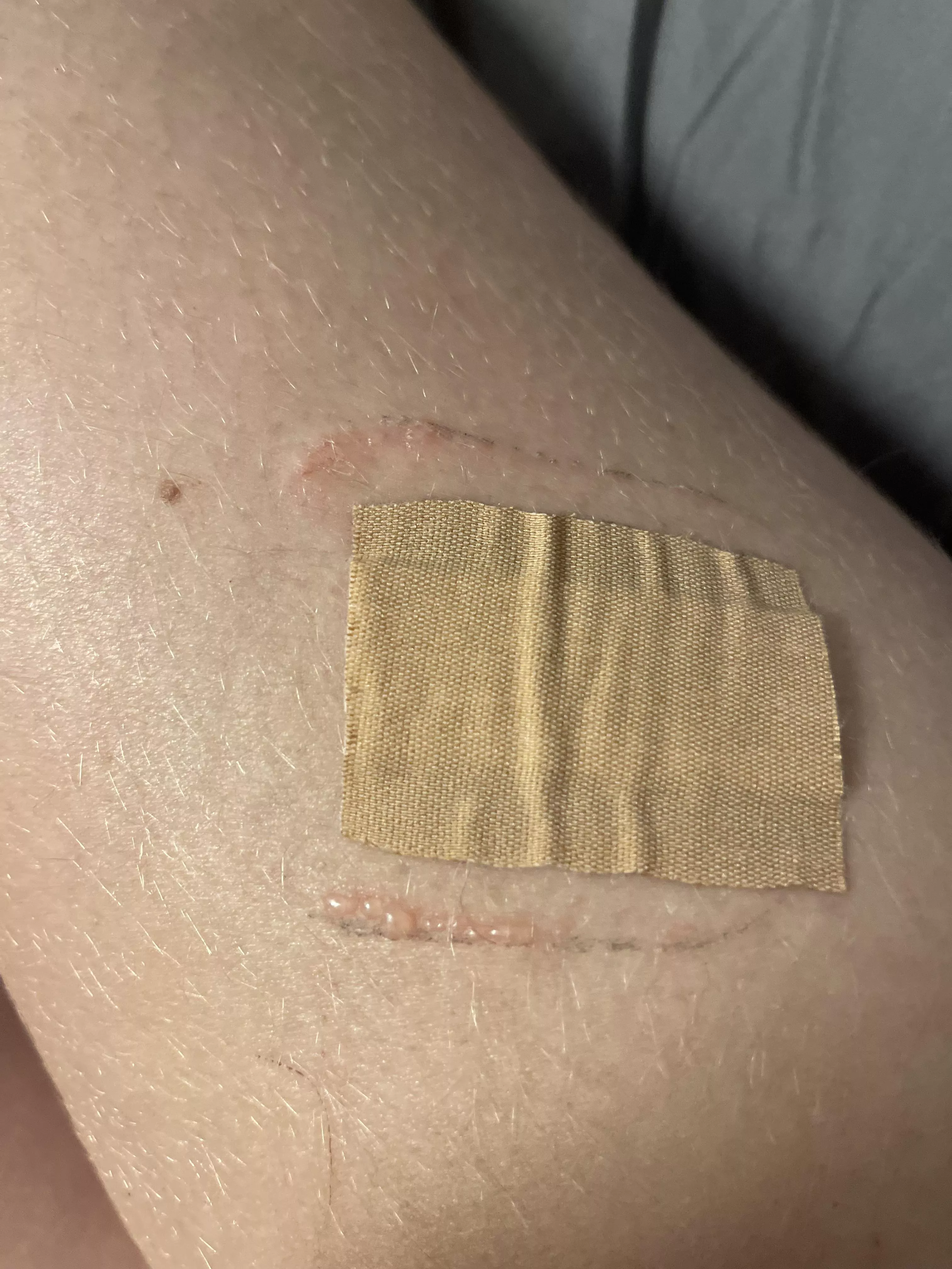 I had an reaction to wound dressing 