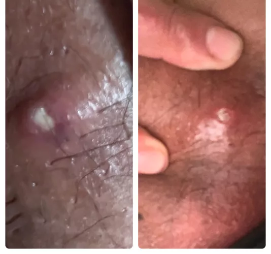 I think I messed up by popping this 