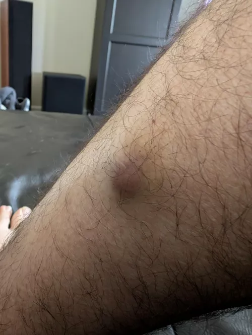 Not sure what this is. Has been on my leg for a couple of years or so. Hasn't gotten larger in a year. I really want to pop it but I instead made an appointment with the dermatologist. I'll try to get footage or poppage!
