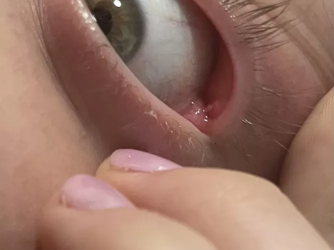 Accidentally popped stye on inner eyelid! 