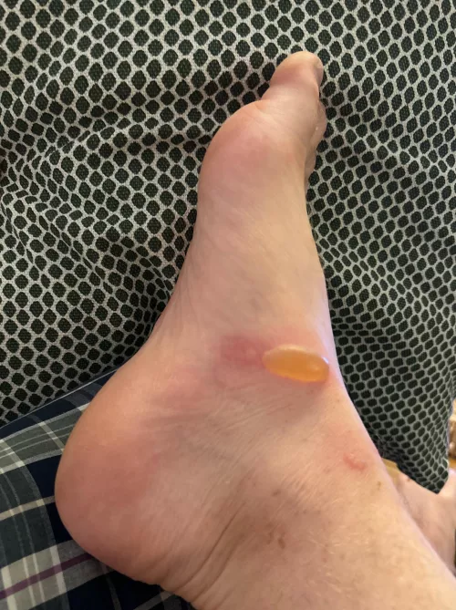 I got sap from a fig tree on my foot