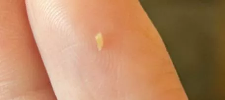 Little things that come out of my back 