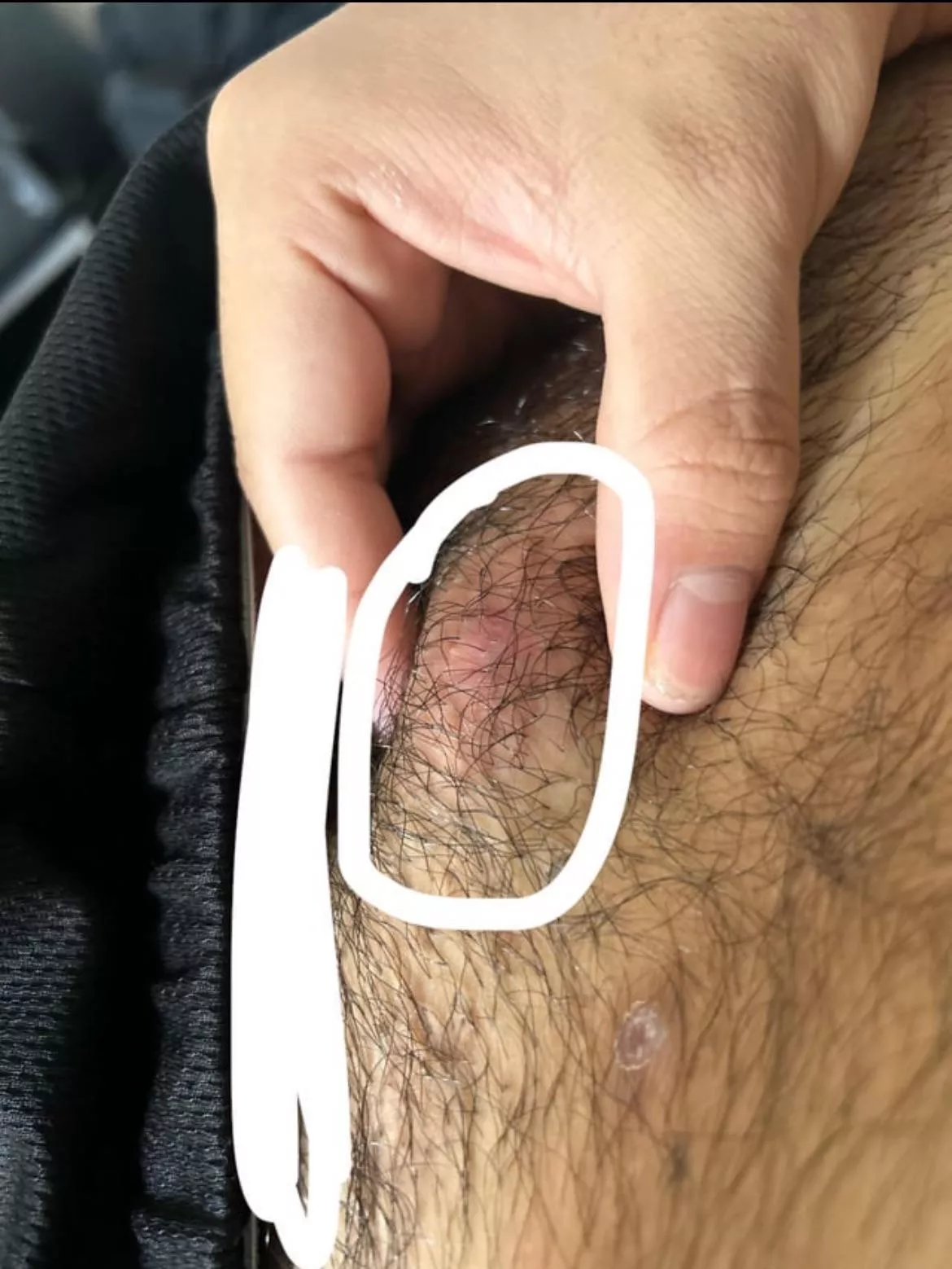 Hard lump on pubic area, it hurts when I touch it too hard or when I wear tight clothing, had for like a day or 2 and I think I’ve gotten these before but never really knew what it is, how it’s caused, and how to get rid of them, if anyone could info