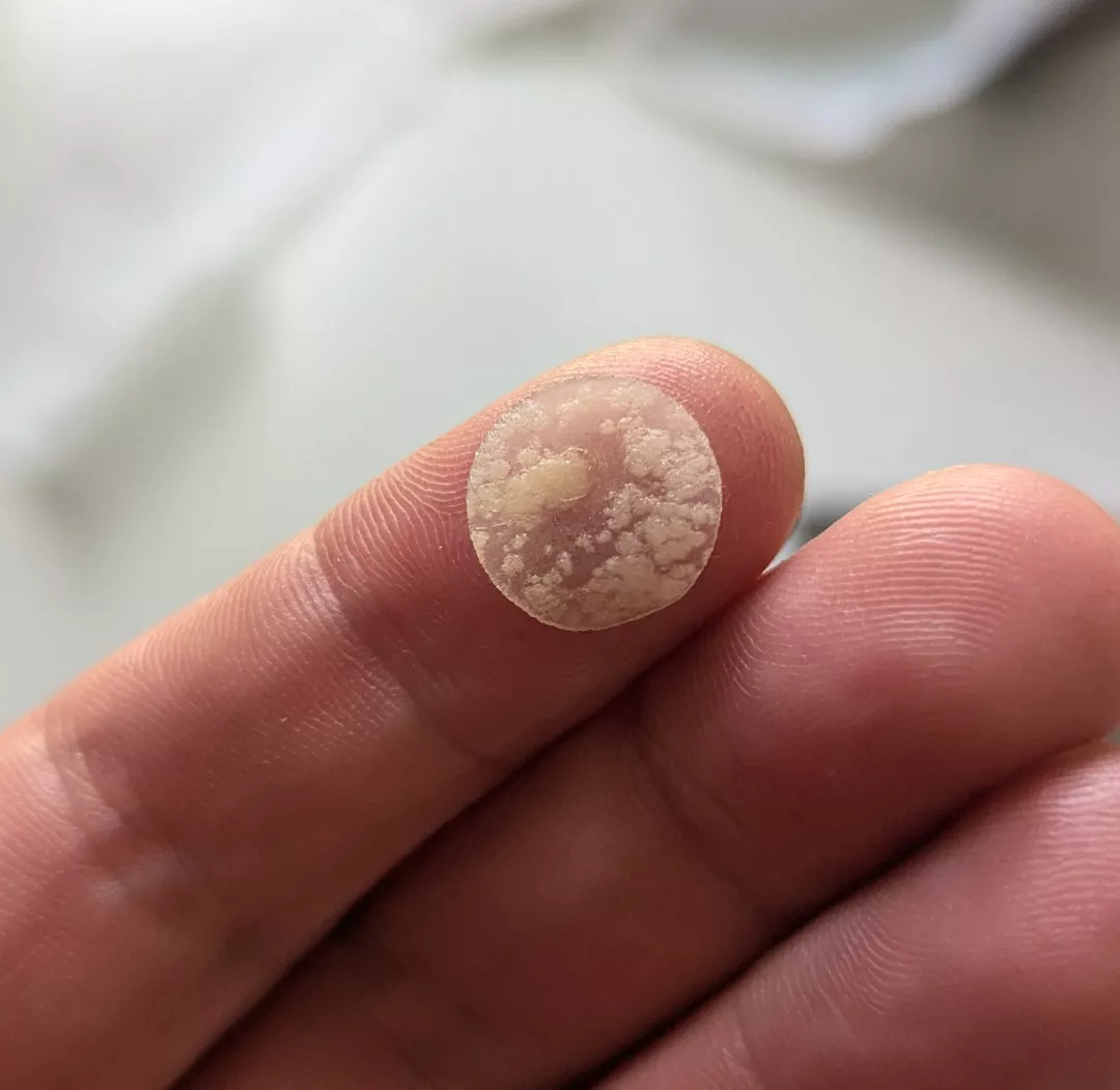 [PIC] My hydrocolloid patch after 3 hours on my aggressive face zit