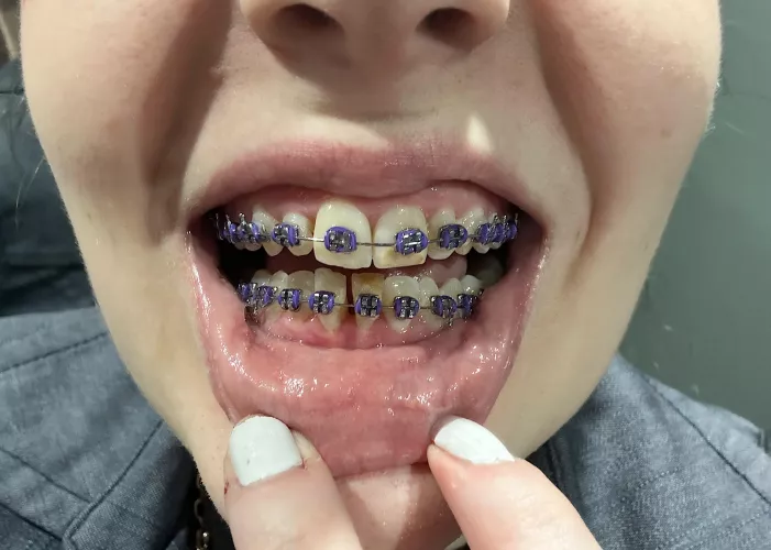 Thread to show my progress: 2 months and purple :3