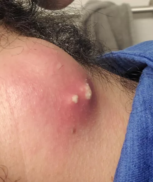 It's getting angry! big boy cyst ready to blow