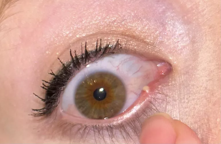 Stye… to pop or not to pop 😅