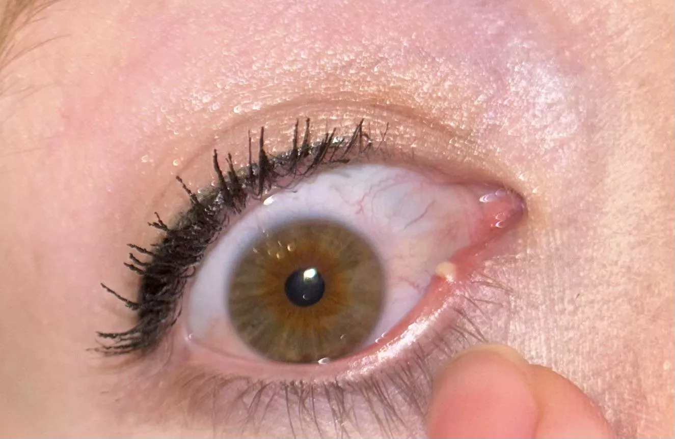 Stye… to pop or not to pop 😅