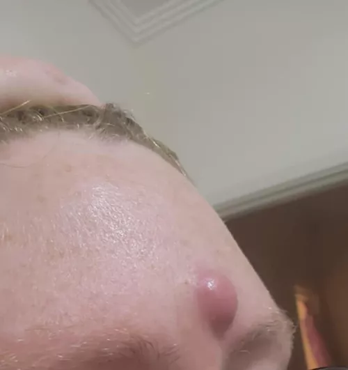 This absolute behemoth my poor friend spawned in the dead middle of their forehead. 