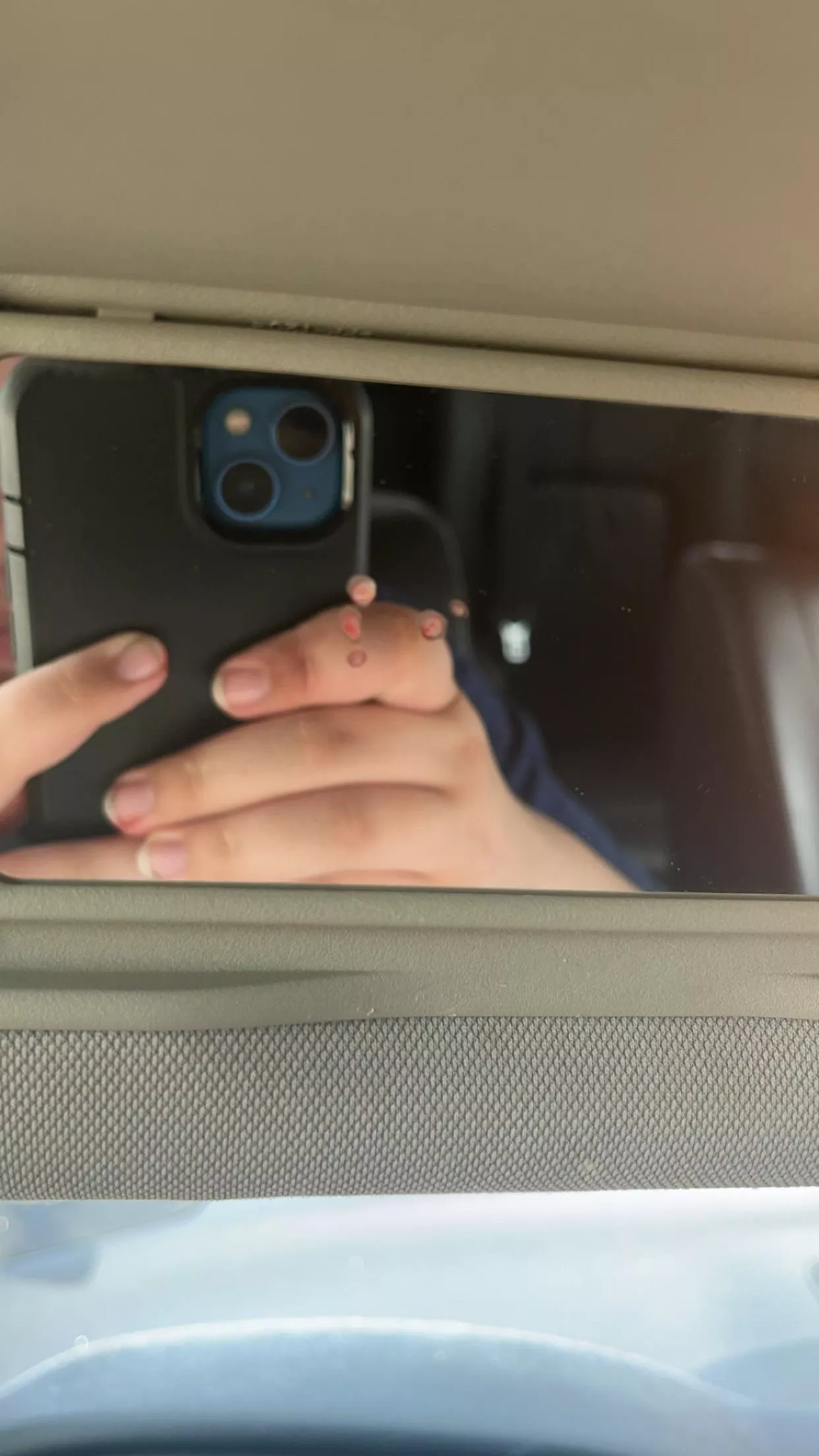 Aftermath of popping a forehead cyst in the car 