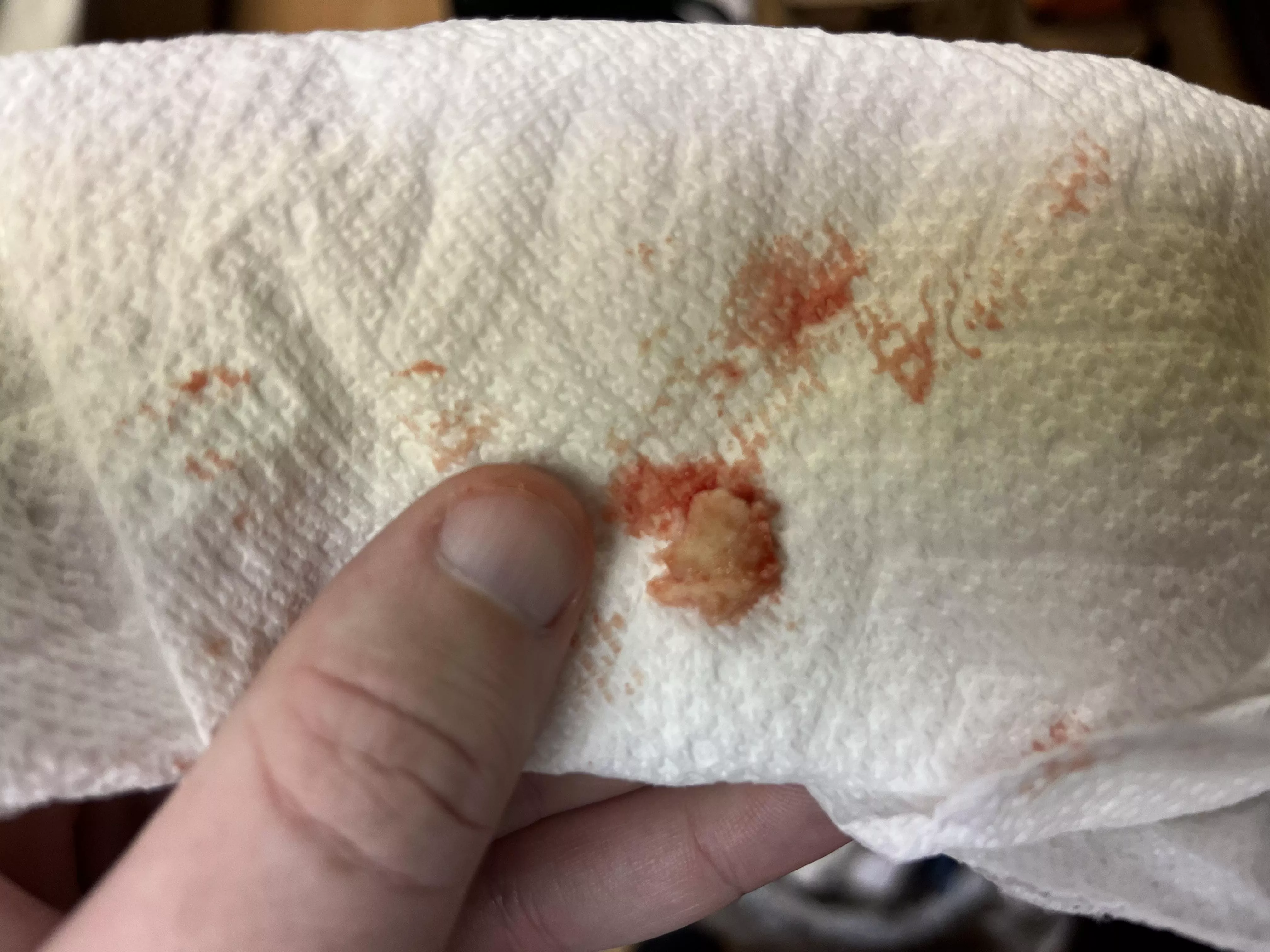 Cyst I just birthed out of my shoulder