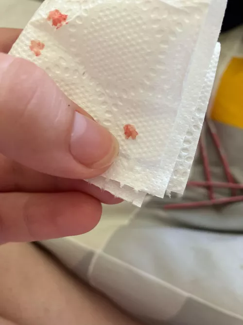 Reoccurring Ingrown toenail. 