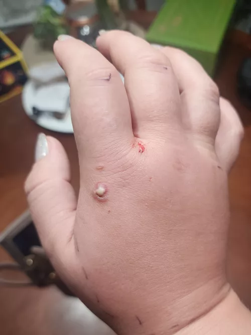 Want to pop it SO BAD