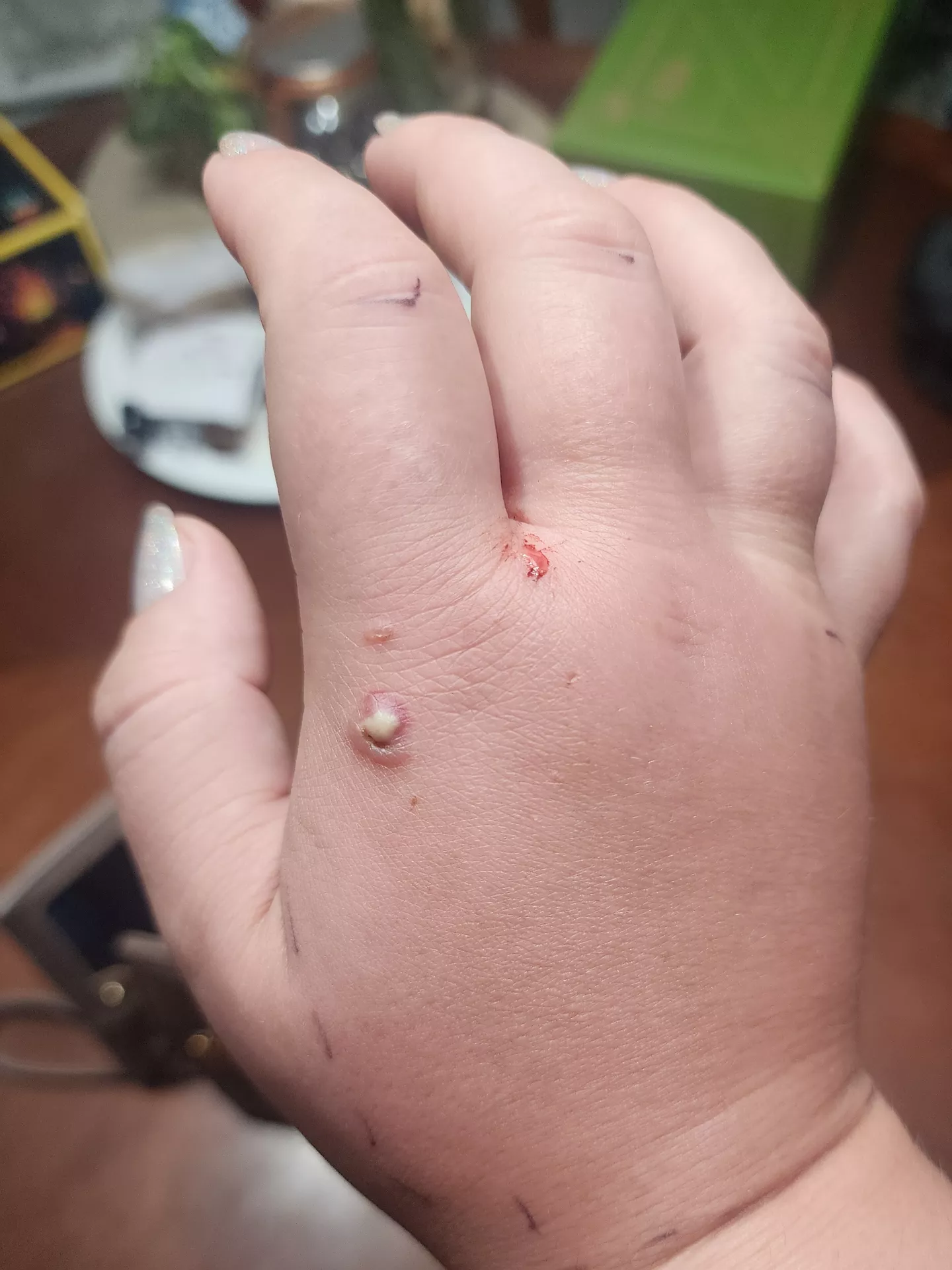 Want to pop it SO BAD