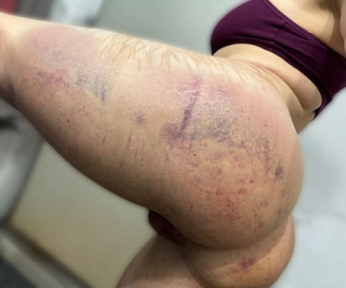 aftermath from a beating