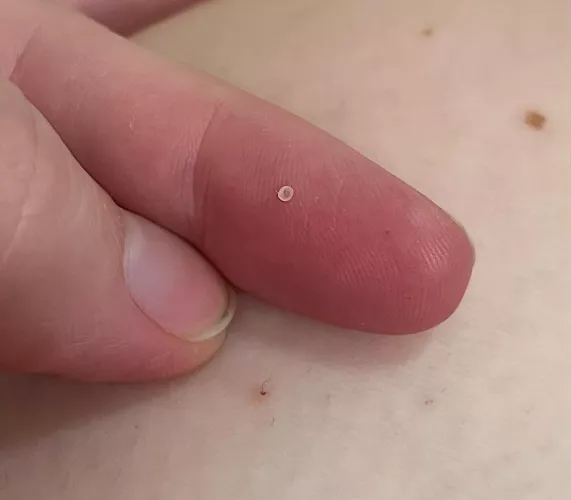 The tiniest, most perfect cyst sac 😂
