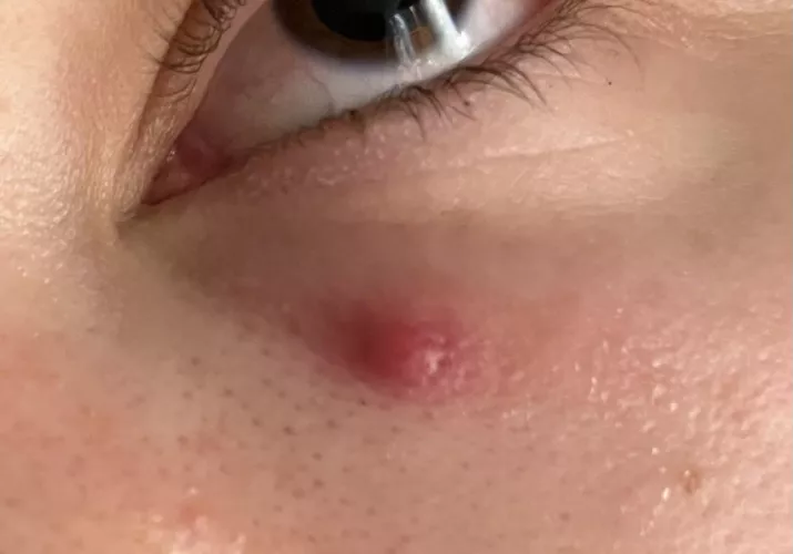 Forbidden under eye pop