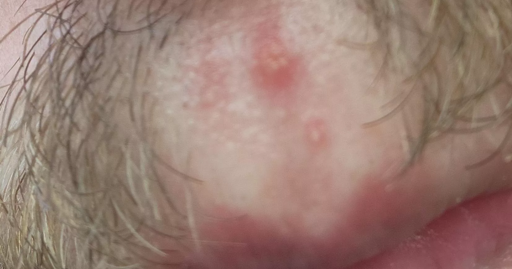 Pimple with multiple heads?