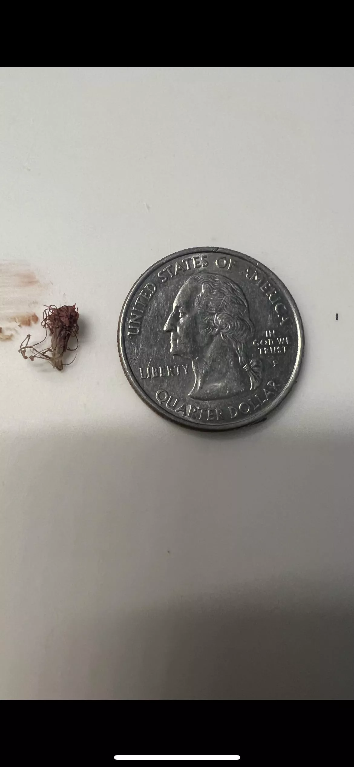 Ingrown hair of 6-7 years, pubic area. 