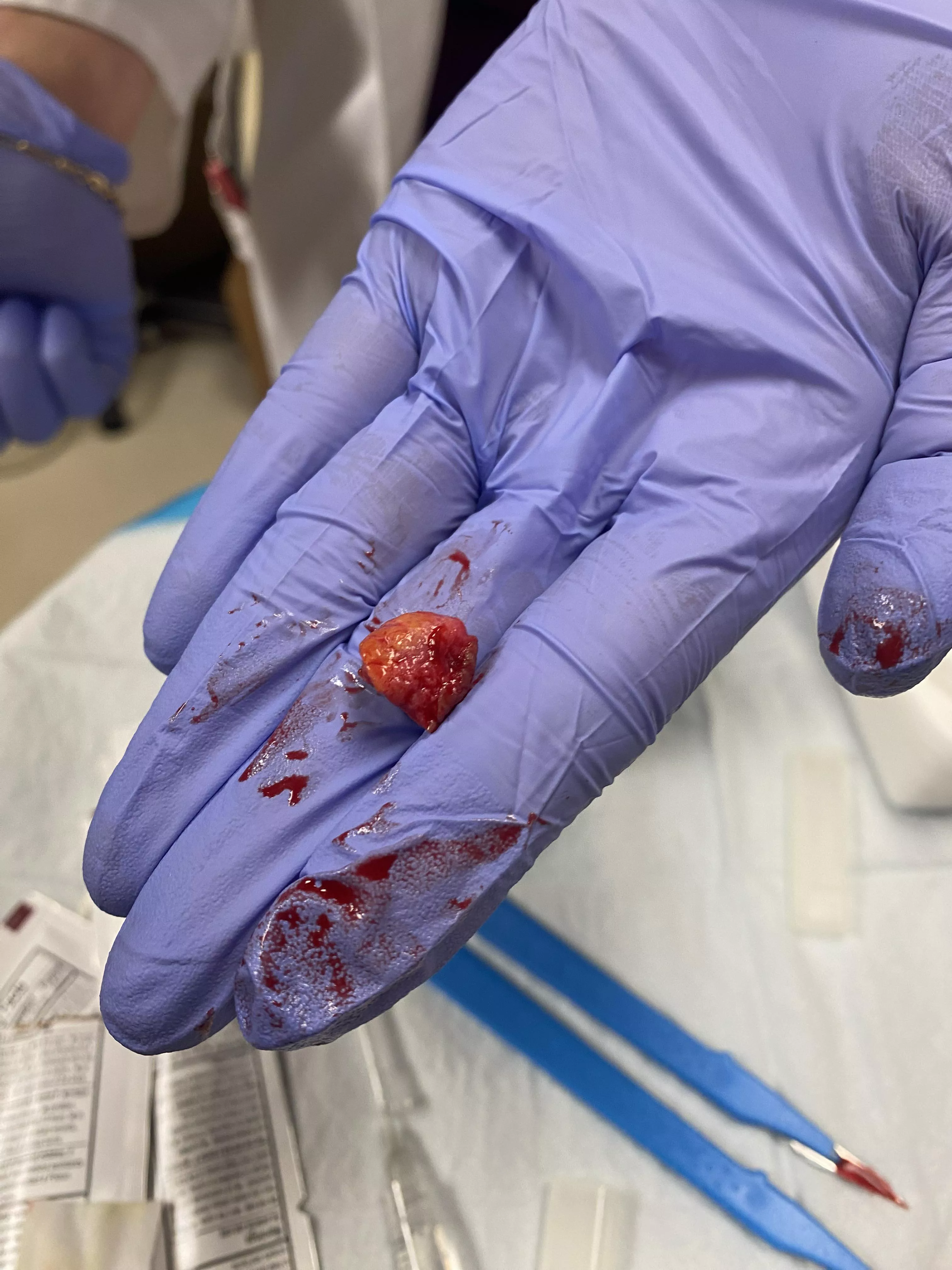 Had this little jewel removed today 