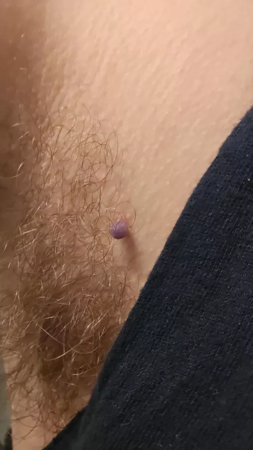 My skin tag about 22 hours after freezing 