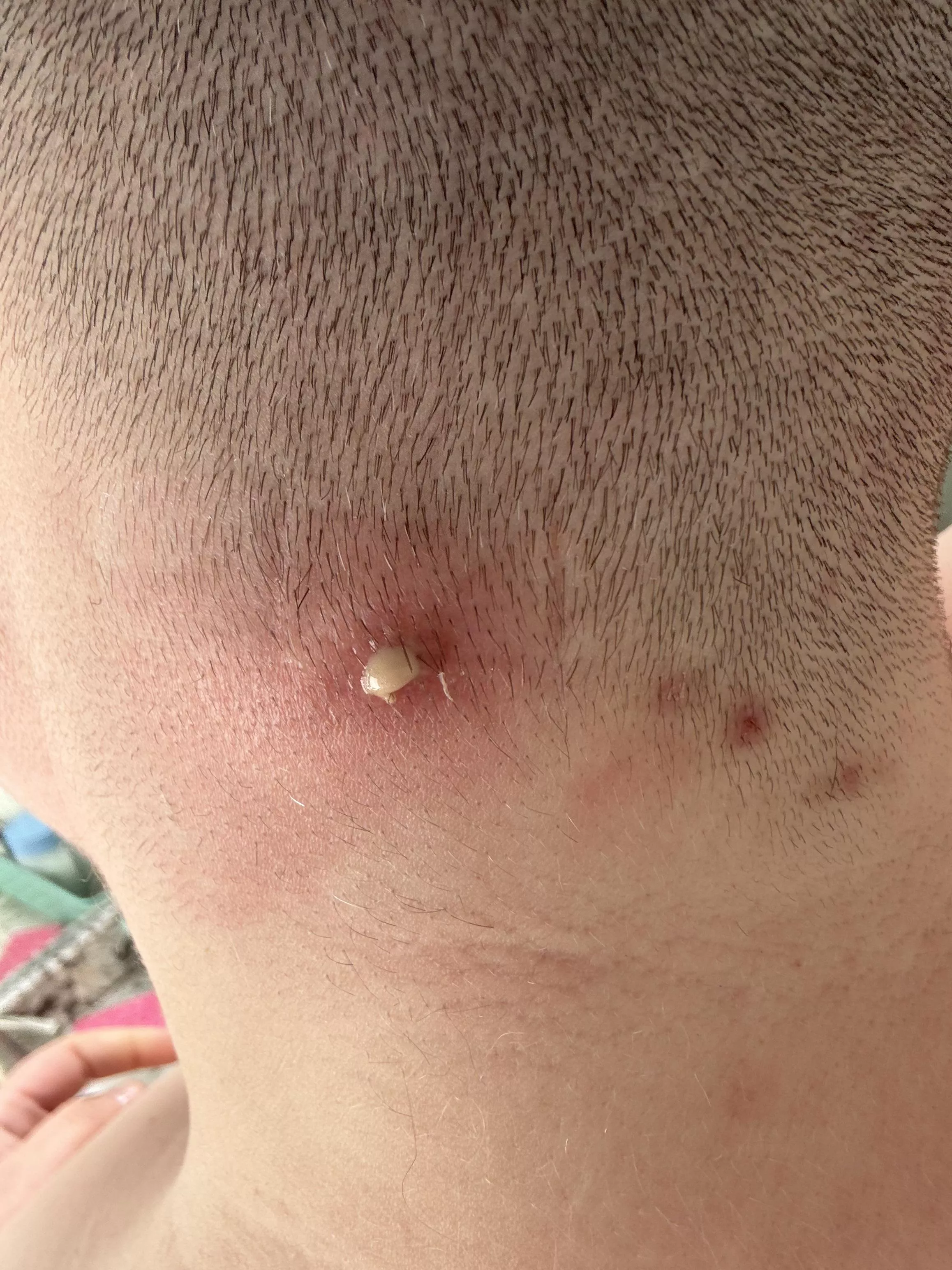 Neck planet update: it’s beginning