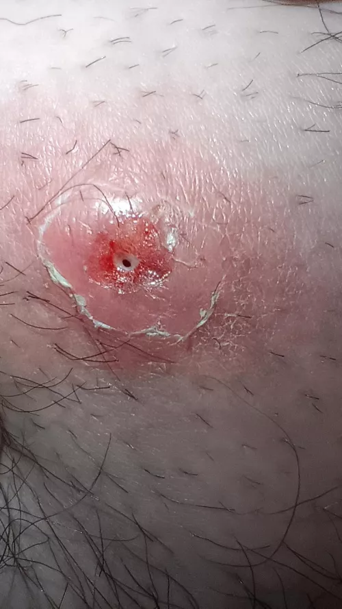Update from thigh pop 