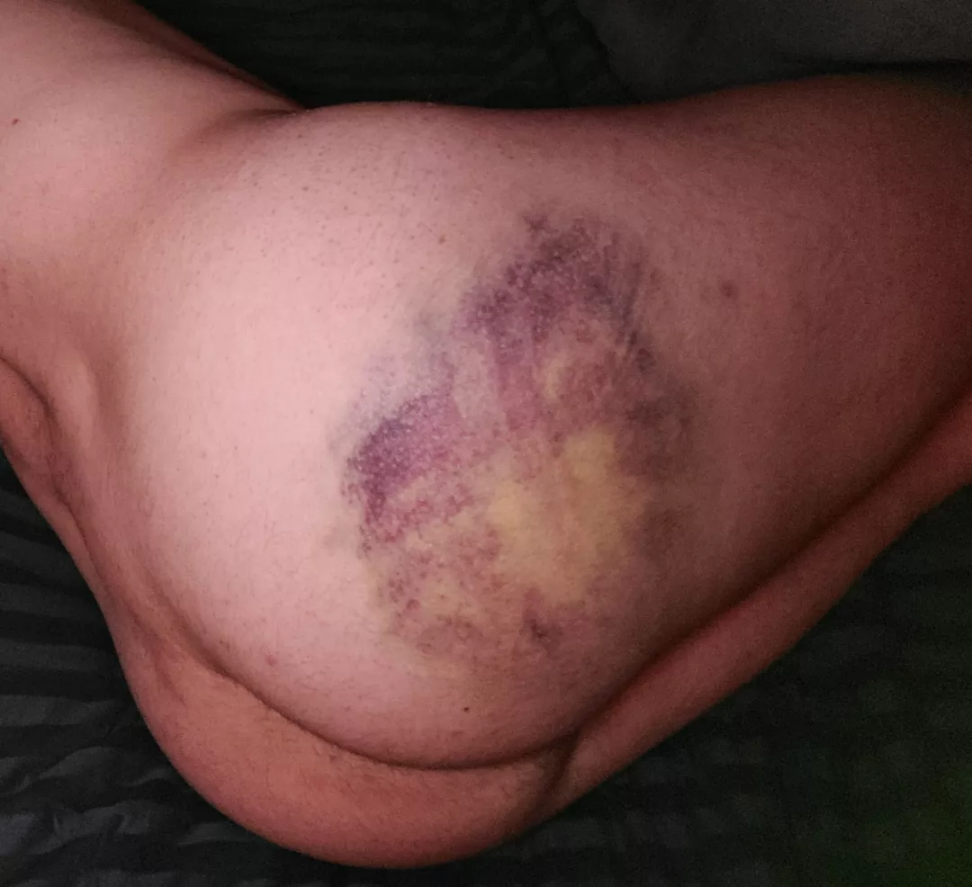 Day after a cable spanking