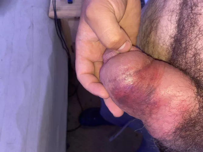 Is this bruising something to be concerned about?