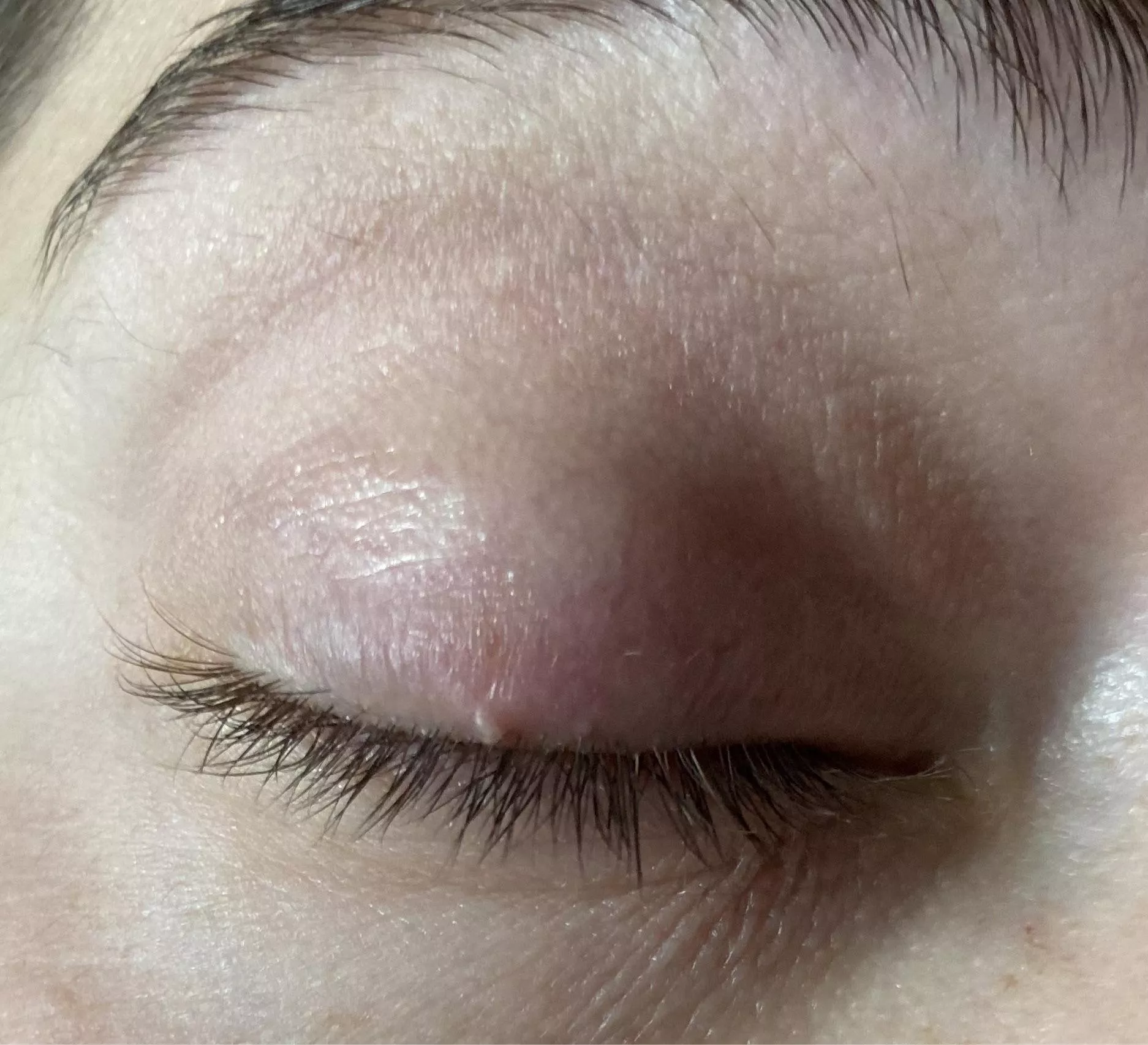 Forbidden eye lid pop