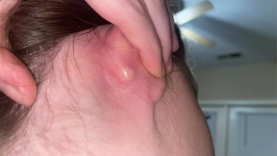 forbidden pop on the back of my ear