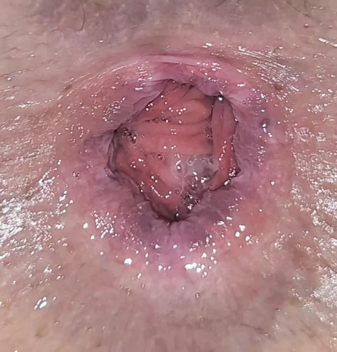 I Heard You Guys Like Busted Bootyholes