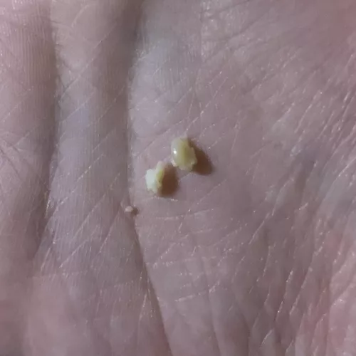 Just got this unexpectedly massive blackhead thing out of my side, sadly didn't get it on video :(