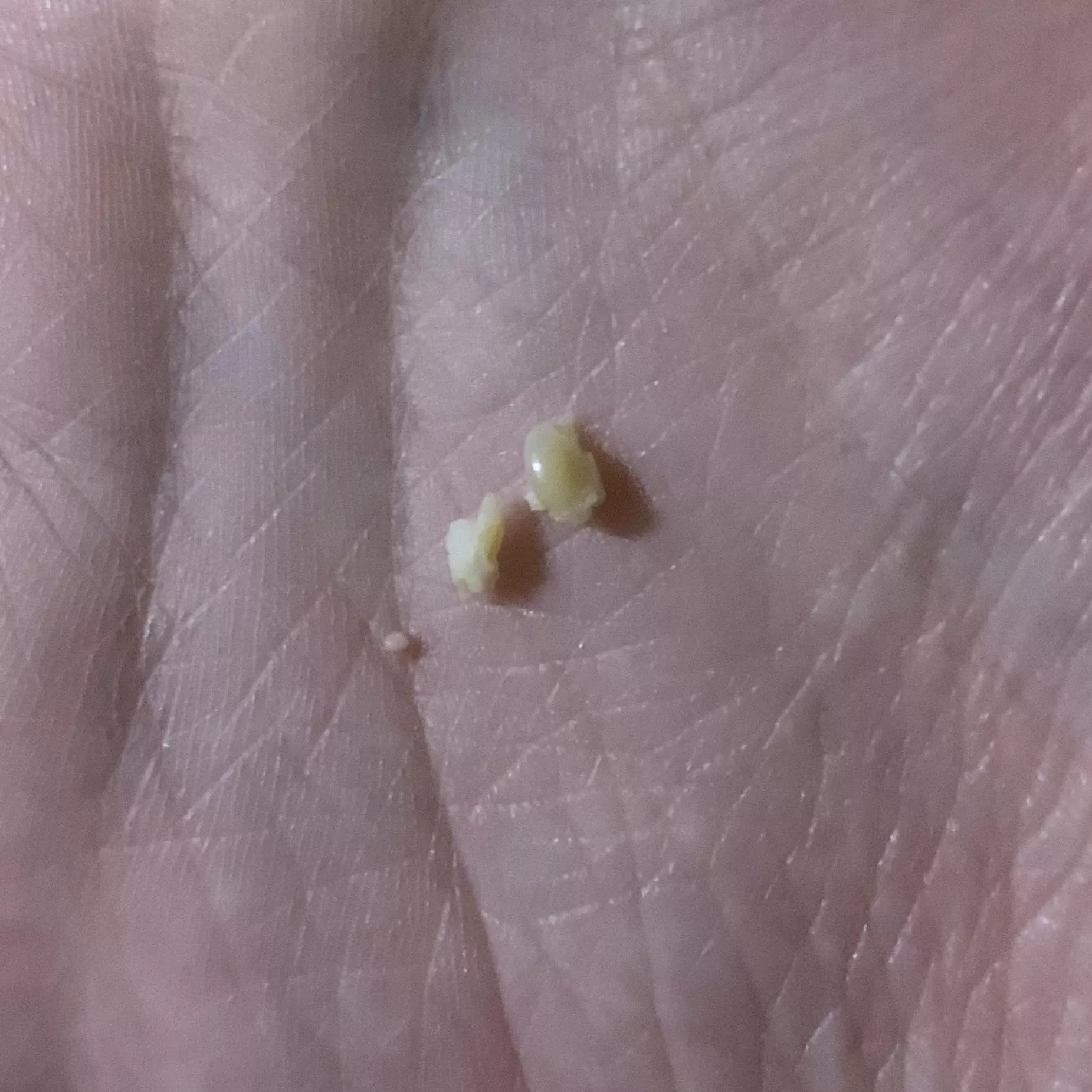 Just got this unexpectedly massive blackhead thing out of my side, sadly didn't get it on video :(
