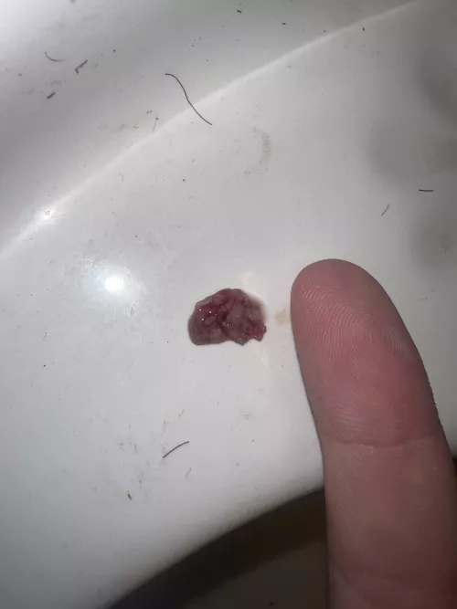 Heres a terrible tonsil stone that formed while I had tonsillitis the past week and a half. (Finger for scale)