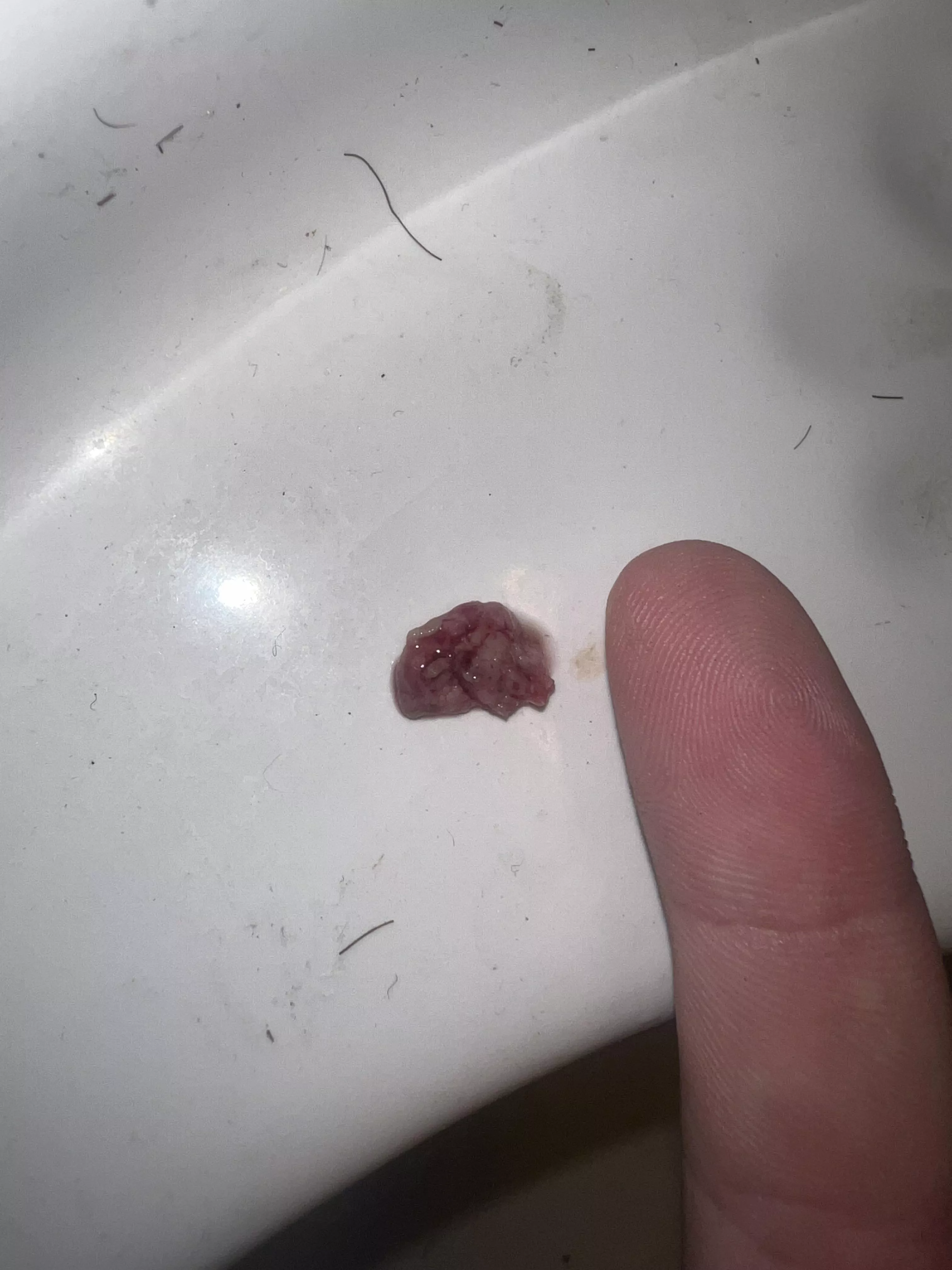Heres a terrible tonsil stone that formed while I had tonsillitis the past week and a half. (Finger for scale)