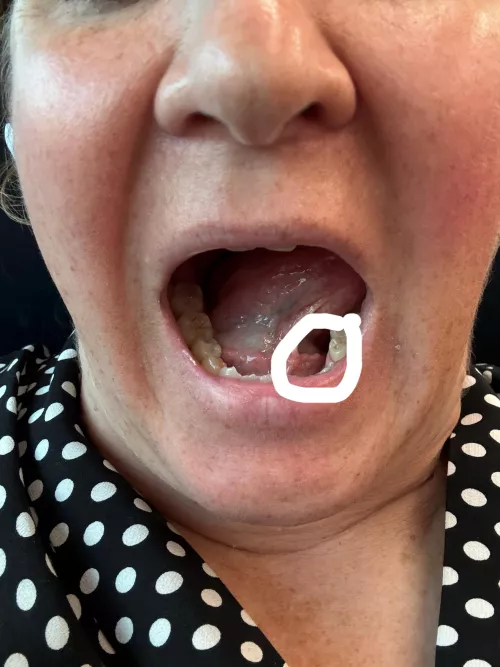 Salivary stones in submandibulsr gland 