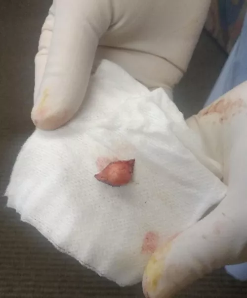 Cyst removed from temple 