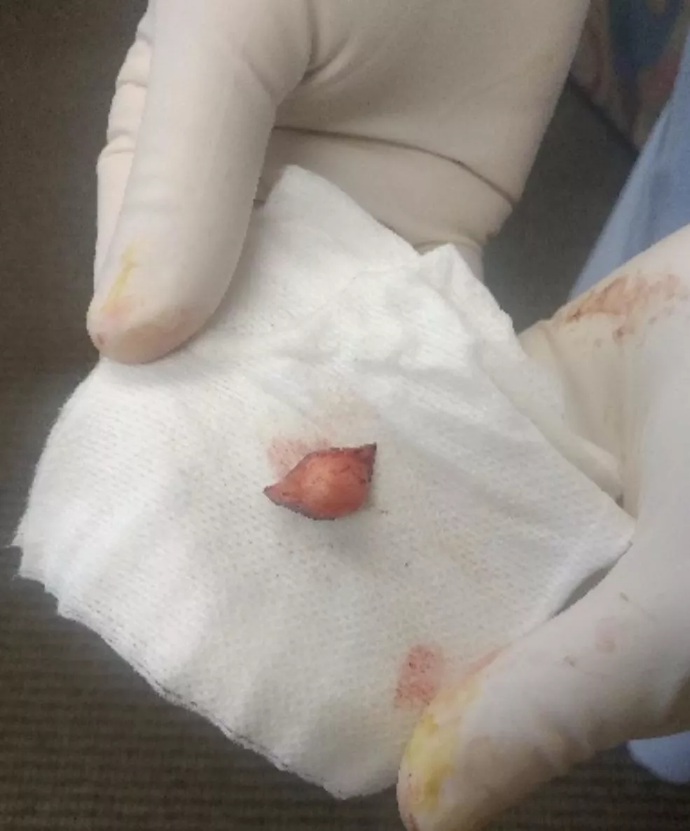 Cyst removed from temple 