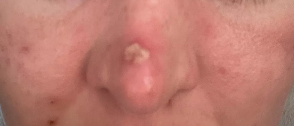 Forbidden pop from skin infection. It took every ounce of willpower not to pick this 