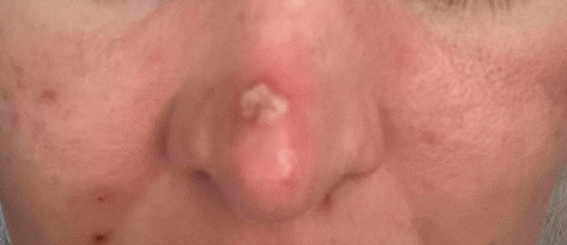 Forbidden pop from skin infection. It took every ounce of willpower not to pick this 
