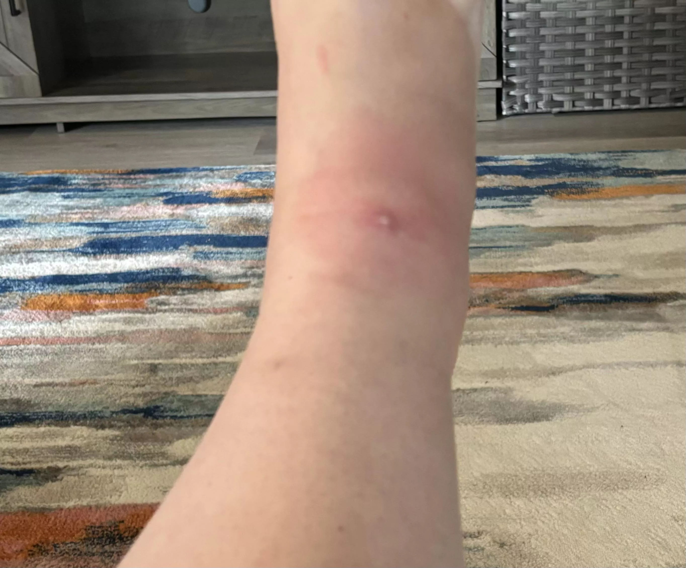 An ant got me and I’m sad it’s a forbidden pop